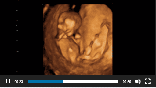 Can You Tell Gender At 14 Weeks 3 Days Reveal 3d 4d Ultrasound Studio Gilbert Az