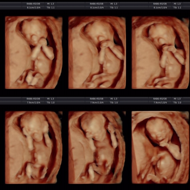 Hd Live Ultrasound 15 Weeks Reveal Ultrasound Studio Gilbert