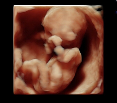 14 week sonogram