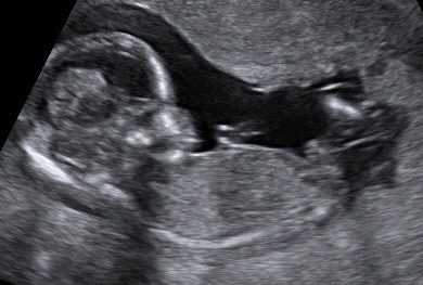 14 week ultrasound black & white