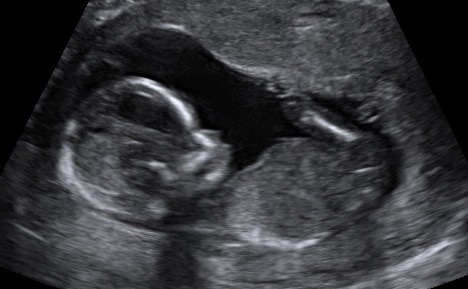 14 week ultrasound black & white