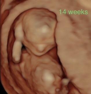 14 week ultrasound 3d
