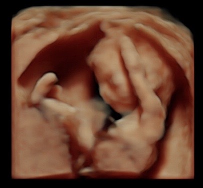 15 week ultrasound