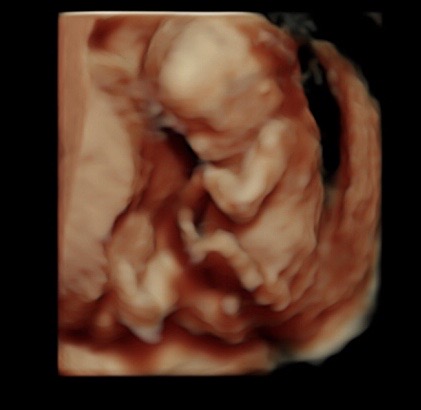 15 Week Ultrasound Reveal 3d 4d Ultrasound Studio