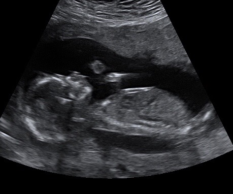 15 week ultrasound black&white