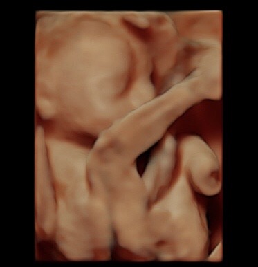 22 week ultrasound