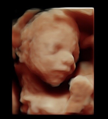 22 week ultrasound