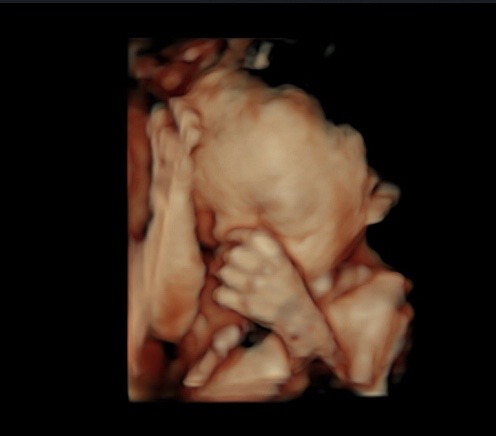 26 week ultrasound