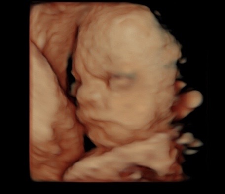 26 week ultrasound