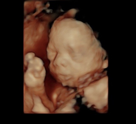 26 week ultrasound