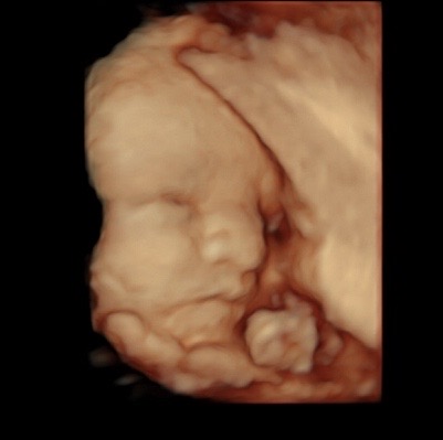 12 week 3d ultrasound