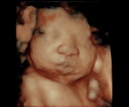 3d/4d ultrasound - 34 weeks