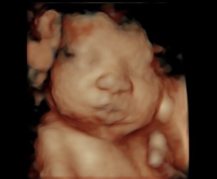 34 Week Ultrasound Reveal 3d 4d Ultrasound Studio