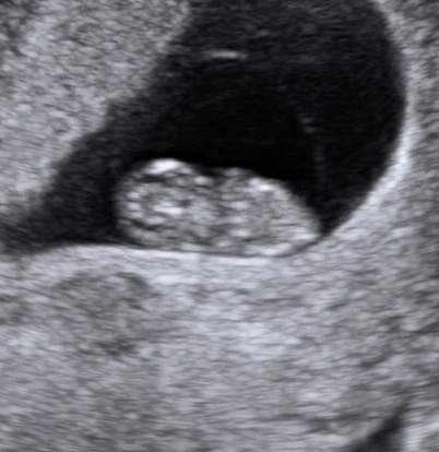 8 week ultrasound