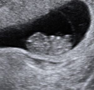 8 Week Ultrasound - Reveal 3D/4D Ultrasound Studio