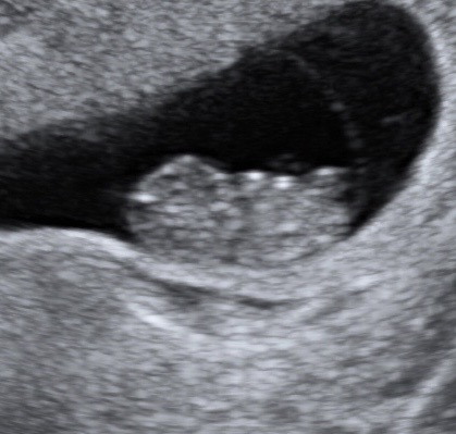 8 week ultrasound