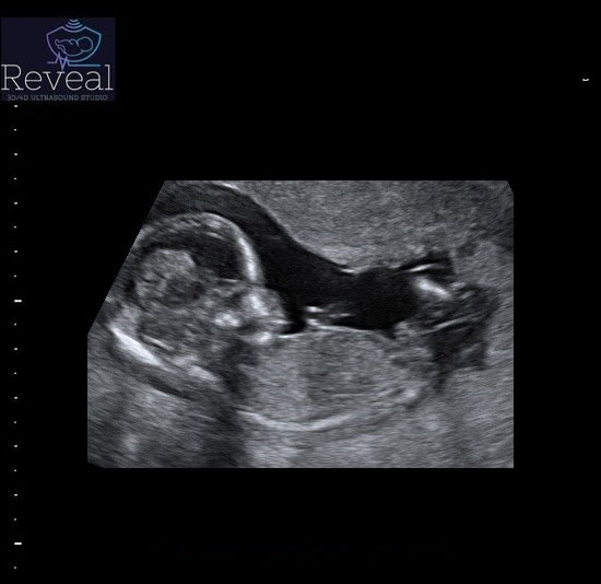 BW Ultrasound - Gender Reveal