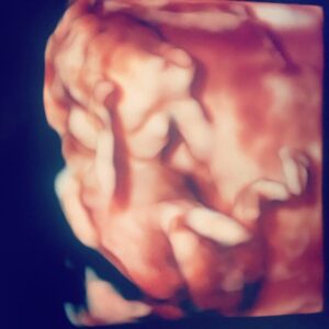 14 Week Ultrasound - 3D 4D Images