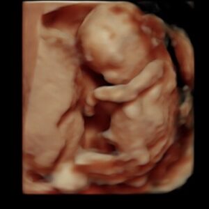 15 week ultrasound
