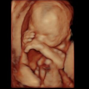 18 weeks ultrasound