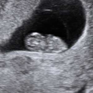 ultrasound at 8 weeks